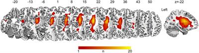 Remote cortical atrophy and language outcomes after chronic left subcortical stroke with aphasia